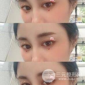 埋线双眼皮手术的注意事项