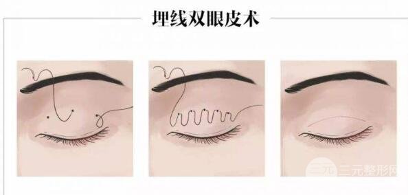 做个埋线双眼皮要多少钱?