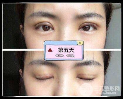 做个埋线双眼皮要多少钱?