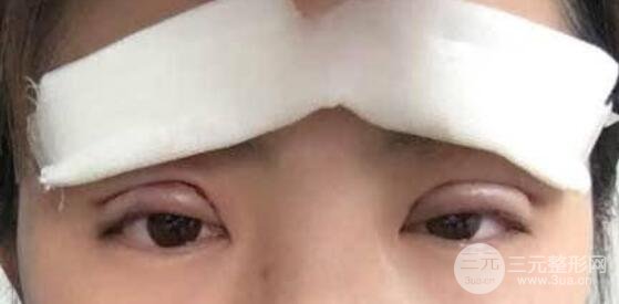 埋线双眼皮术需要注意什么?