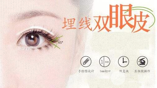埋线双眼皮有哪些优缺点?适合人群有哪些?