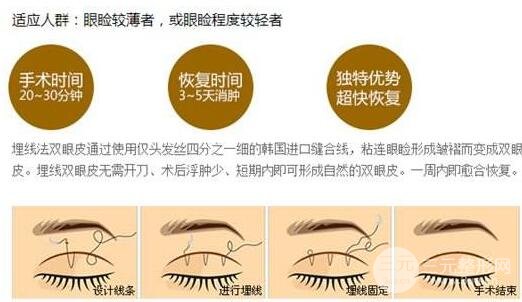 埋线双眼皮的适合人群有哪些?