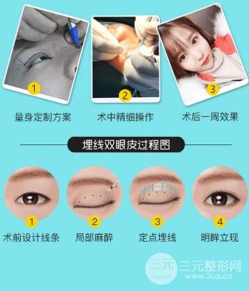 埋线双眼皮需要拆线吗?多久能恢复?