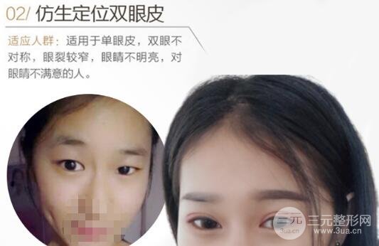 定点双眼皮损伤介绍
