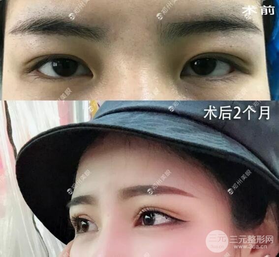 定点双眼皮恢复时间是多久恢复自然