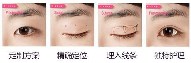 定点双眼皮手术原理