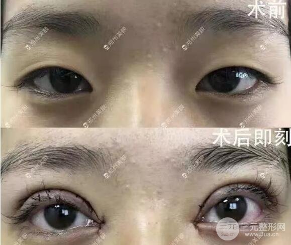 定点双眼皮果好不好