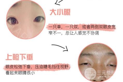 定点双眼皮价格贵吗 多少钱