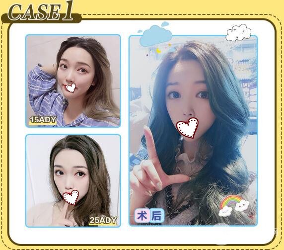 定点双眼皮多少钱 可以保持多久？