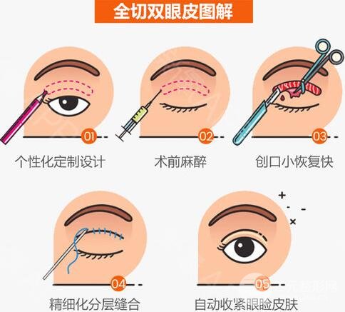 切开双眼皮怎么做的？手术过程图