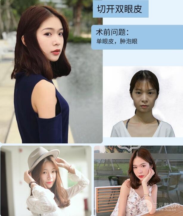 切开双眼皮怎么做的 果图 案例图