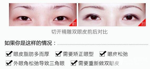 切开双眼皮一般多少钱 哪些适合