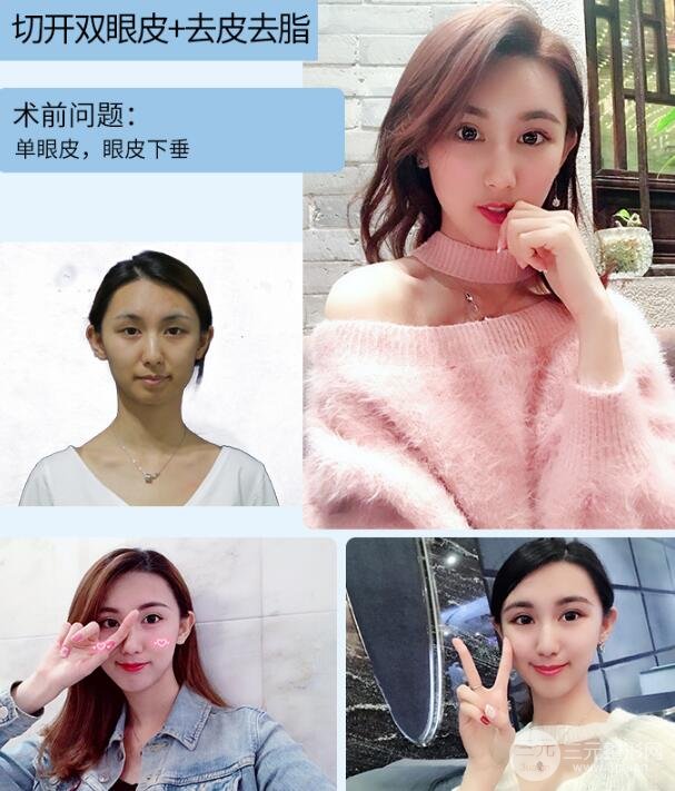 切开双眼皮一般多少钱 果好不好 案例图
