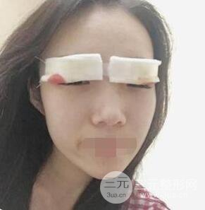 埋线双眼皮术后要注意哪些?