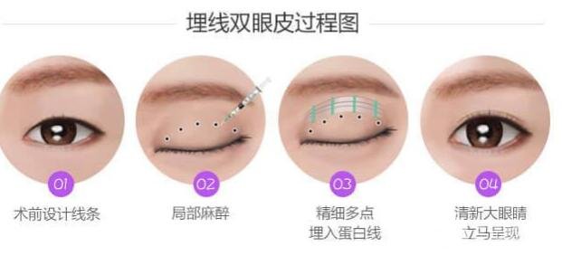 埋线双眼皮的费用