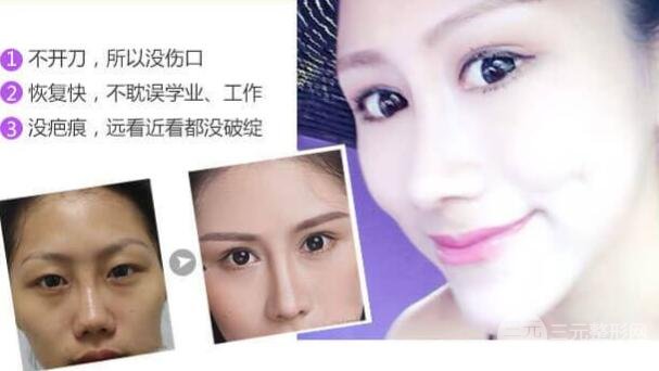 埋线双眼皮能维持几年?