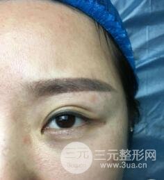 埋线双眼皮后的注意事项