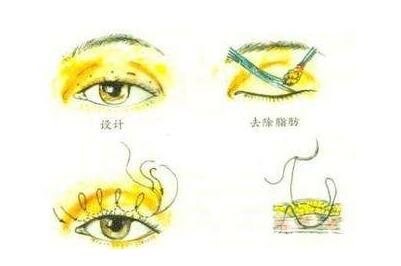 埋线双眼皮的适应人群