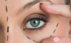 埋线双眼皮能保持多久？维持时间是多久？