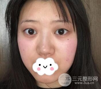 埋线双眼皮手术案例