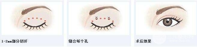 埋线双眼皮可以做第二次吗?