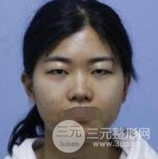埋线双眼皮手术案例