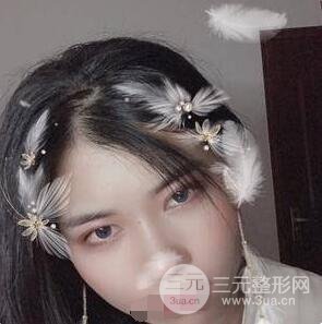 埋线双眼皮手术案例