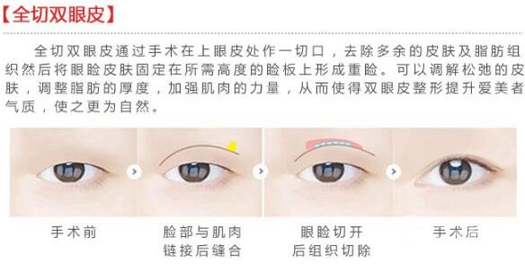 科普|切开双眼皮手术简介