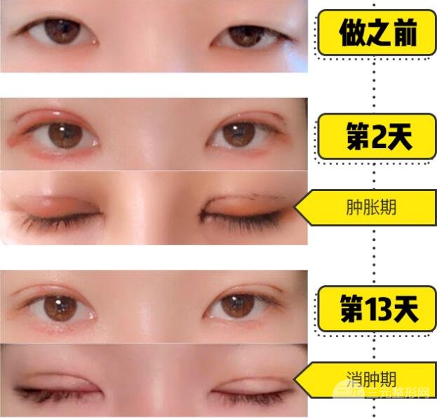 切开双眼皮术后果图
