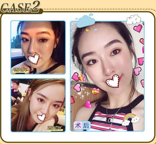 切开双眼皮后遗症严重吗 术后注意事项