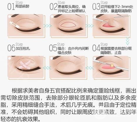 切开双眼皮手术原理简介