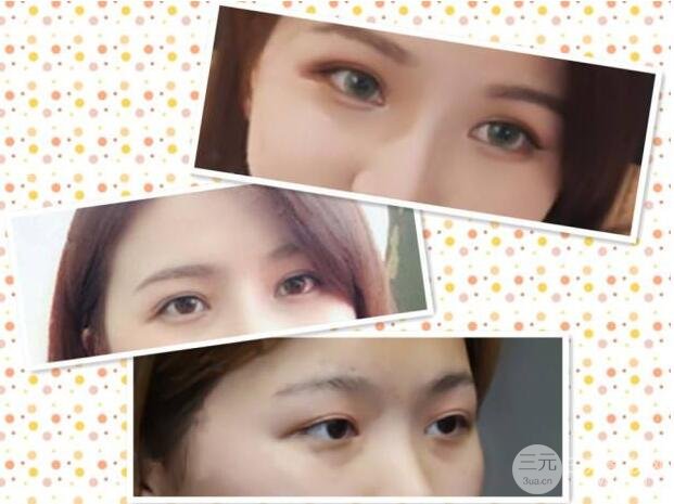 切开双眼皮多久可以恢复自然微创 案例图