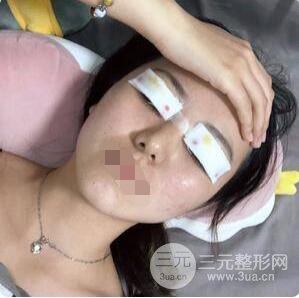 埋线双眼皮术后要注意什么?