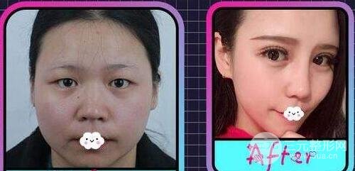 埋线双眼皮手术案例