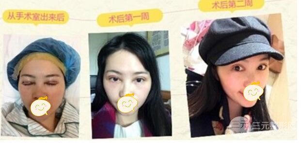 埋线双眼皮多久能完全恢复?
