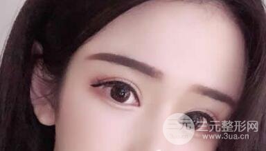 埋线双眼皮多久能完全恢复?