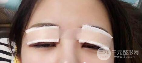埋线双眼皮手术后应注意的事项