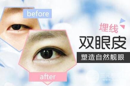埋线双眼皮多久恢复自然?