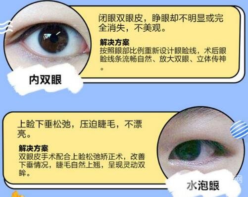 切开双眼皮适合哪些人