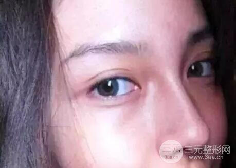全切双眼皮增生会消失吗 多久能化妆
