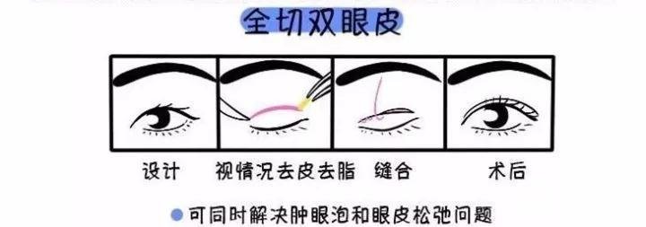 全切双眼皮疼不疼?怕疼星人戳进来康康!