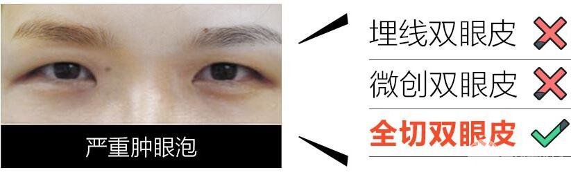全切双眼皮适合哪些人