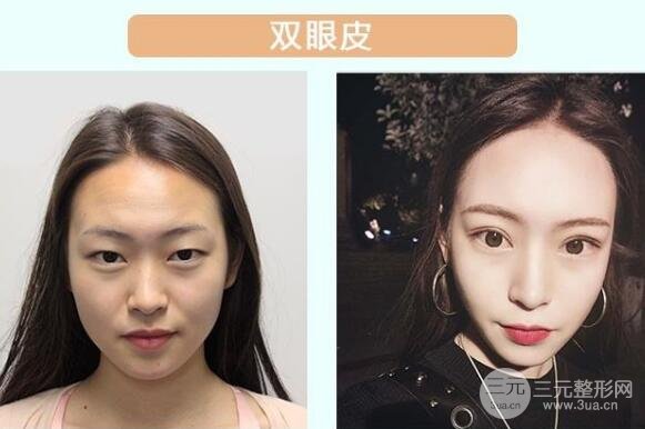 全切双眼皮案例图