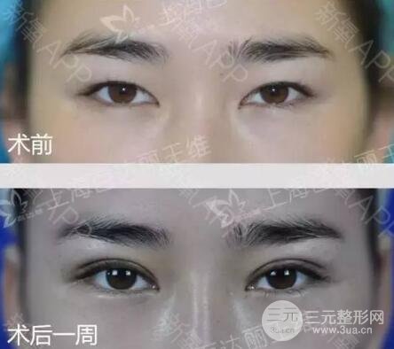 全切双眼皮果图