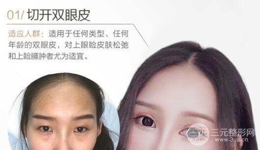 全切双眼皮是长时间的吗