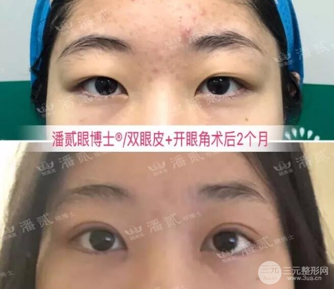 全切双眼皮手术果图 案例
