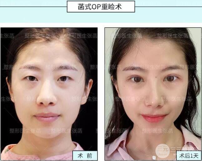 全切双眼皮术后果图