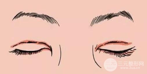 双眼皮手术后需要注意什么?