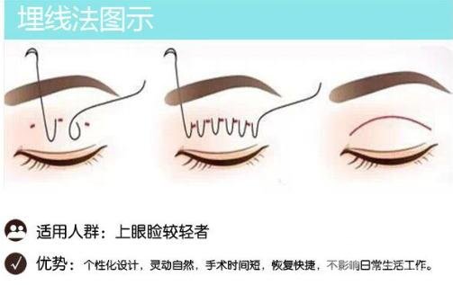 割双眼皮和埋线有什么区别?