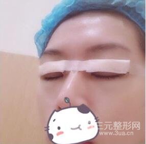 双眼皮手术后需要注意什么?